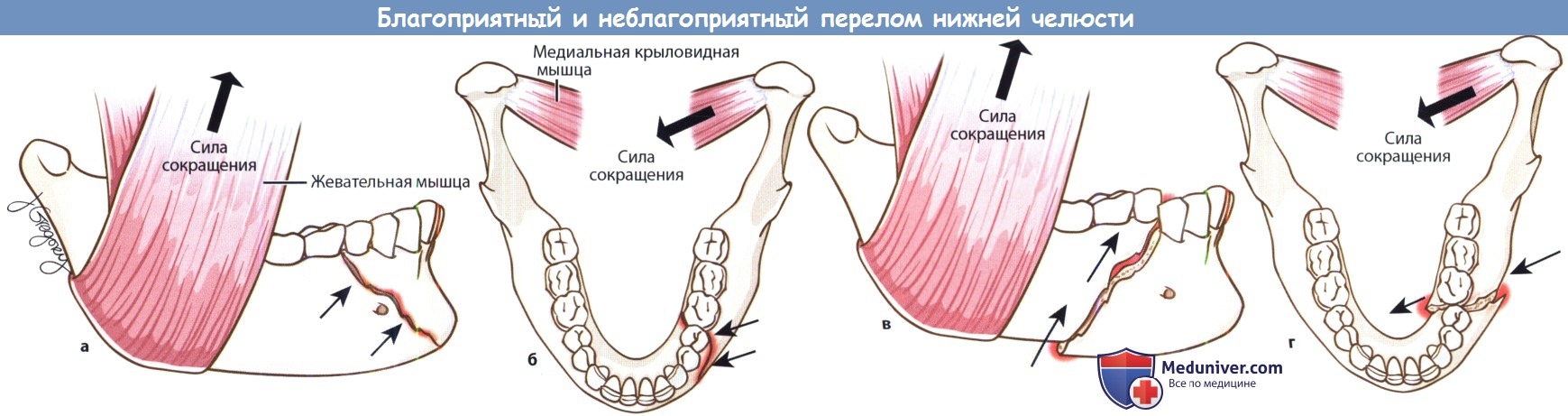 Благоприятный и неблагоприятный переломы нижней челюсти