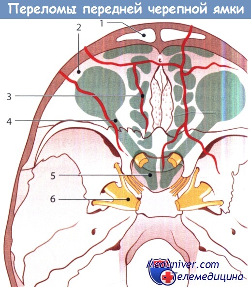 Череп мкб 10. Симптомы перелома передней черепной ямки. Переломы основания черепа передней черепной ямки. Перелом черепа у основания передней ямки. Перелом задней черепной ямки.