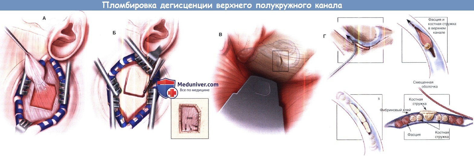 Синдром разрыва верхнего канала уха thumbnail