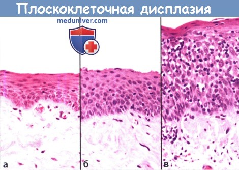 Цитология (гистология) плоскоклеточной дисплазии слизистой рта