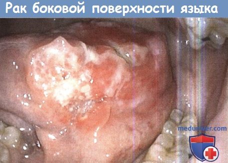 Рак боковой поверхности языка