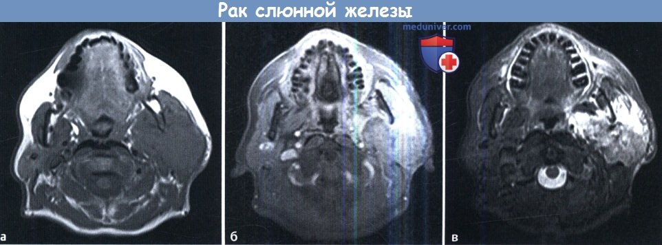 МРТ при раке слюнной железы