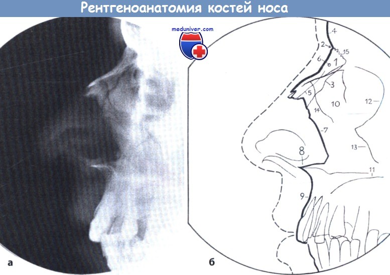 Рентгеноанатомия костей носа