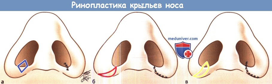 Ринопластика крыльев носа