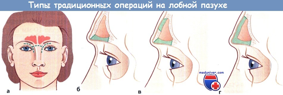 Типы традиционных операций на лобной пазухе