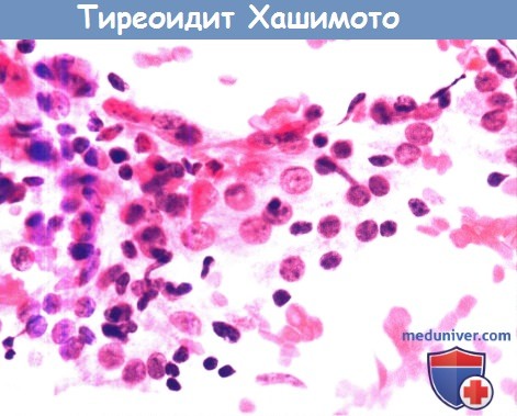 Цитология (гистология) щитовидной железы при тиреоидите Хашимото