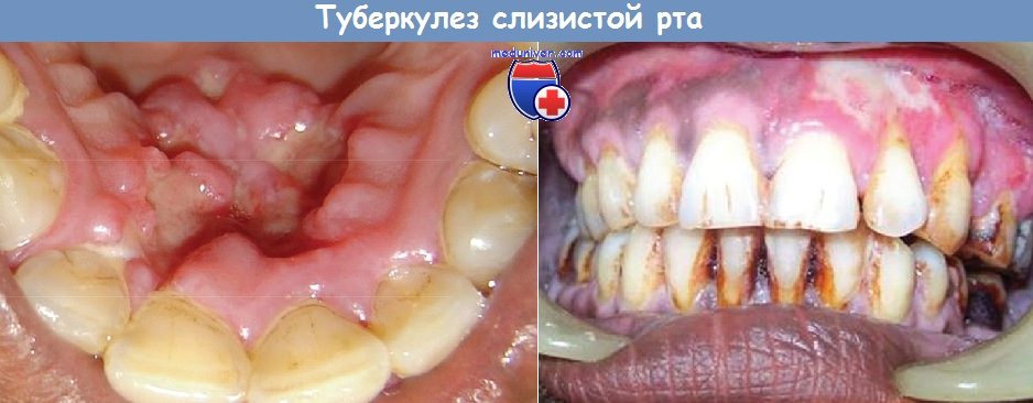 Туберкулез полости рта