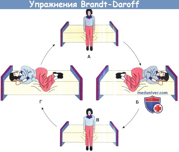 Упражнения Brandt-Daroff при вестибулярном головокружении