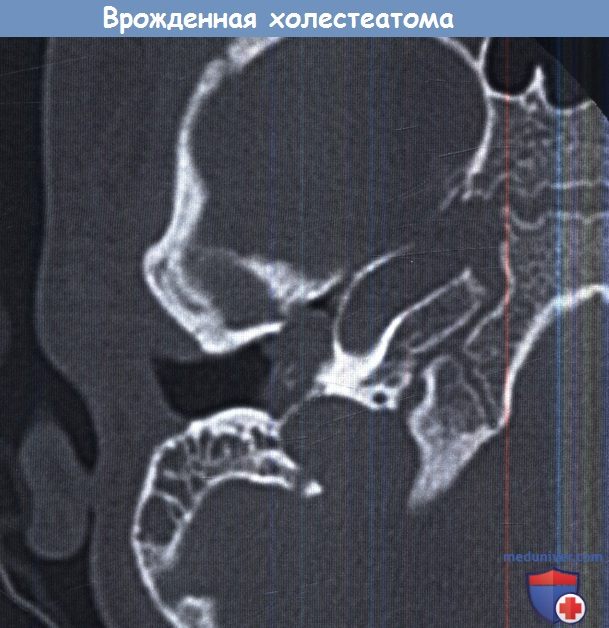 Врожденная холестеатома