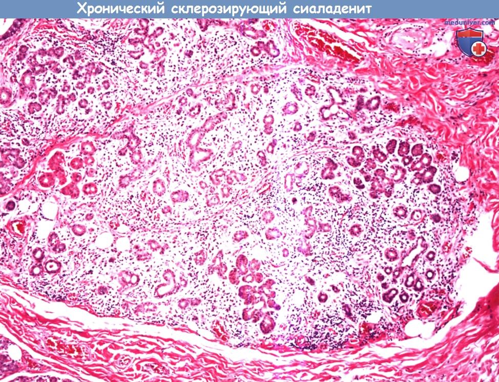 Цитология (гистология) слюнной железы при хроническом склерозирующем сиаладените