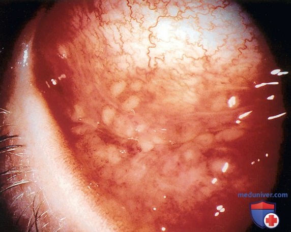 ������� �������� ������� (Bartonella henselae) � �������
