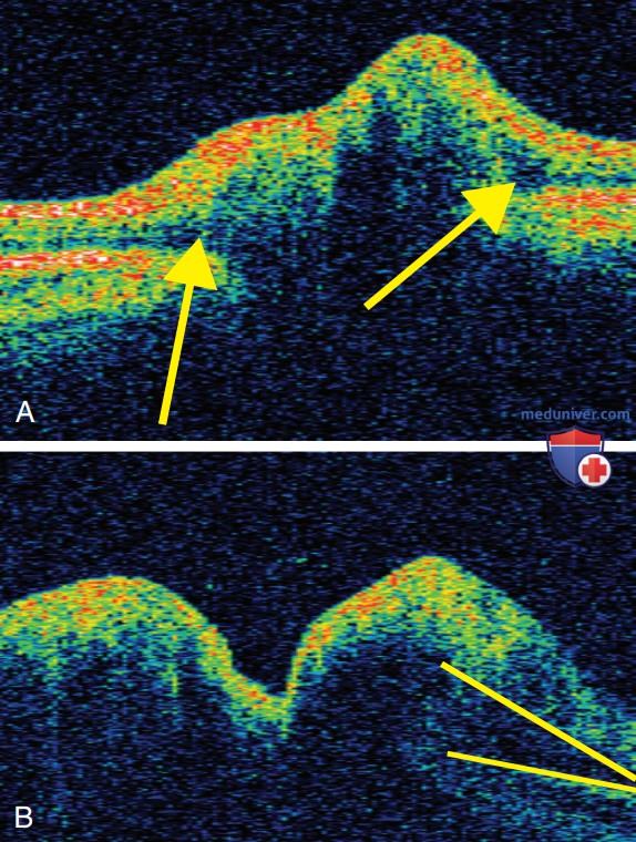    (pseudotumor cerebri)  