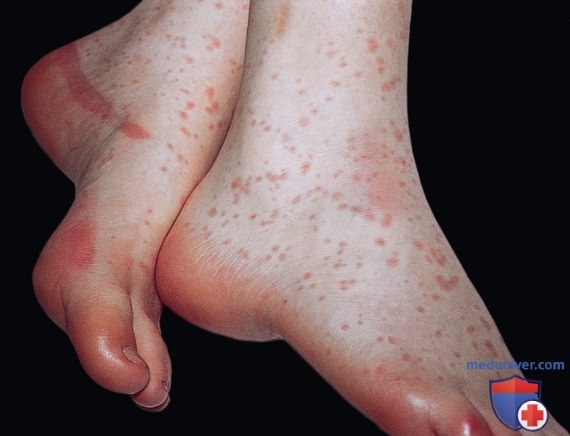 Neisseria meningitidis (�����������) � �������