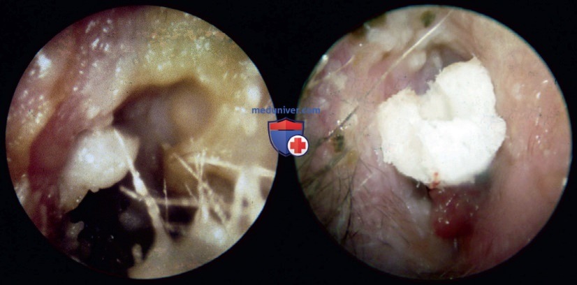   (otitis externa)  