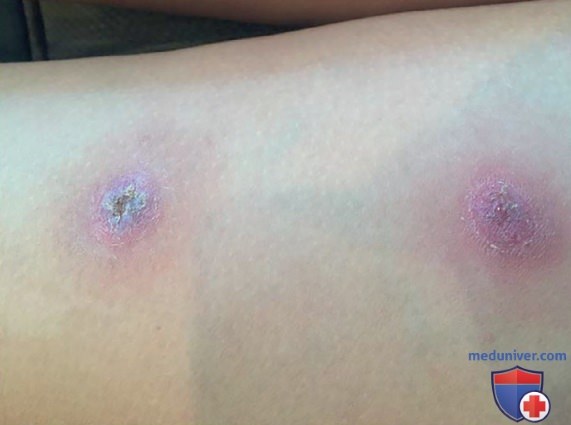 Burkholderia � �������