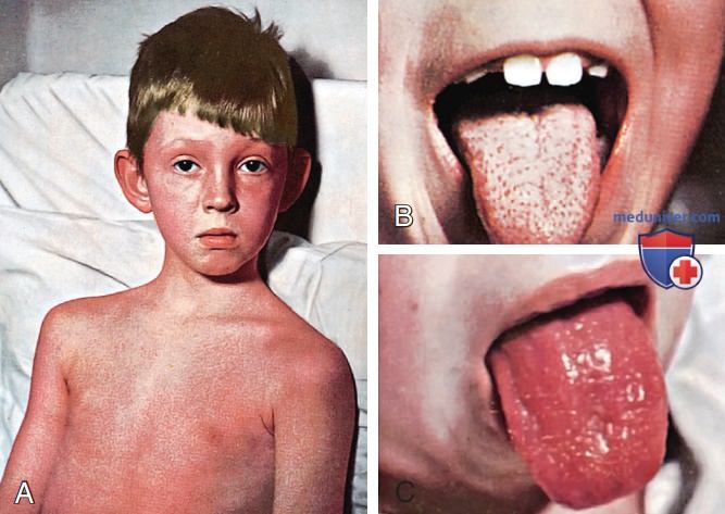 ����������� ������ A (Streptococcus pyogenes) � �������