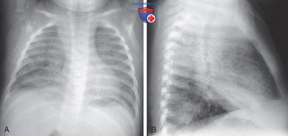 ���������� (Mycobacterium tuberculosis) � �������