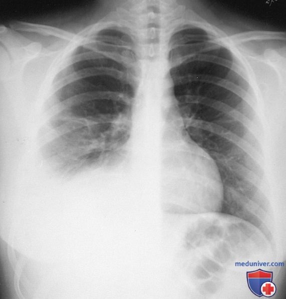 ���������� (Mycobacterium tuberculosis) � �������