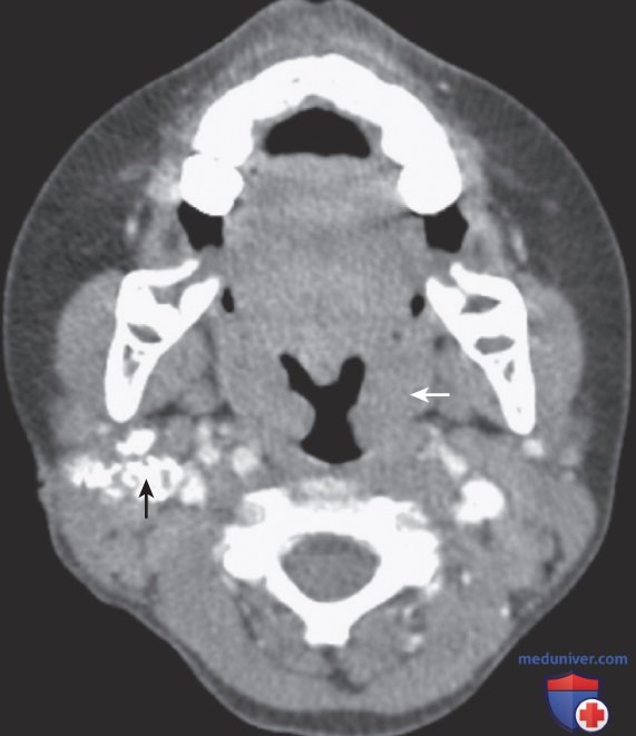 ���������� (Mycobacterium tuberculosis) � �������