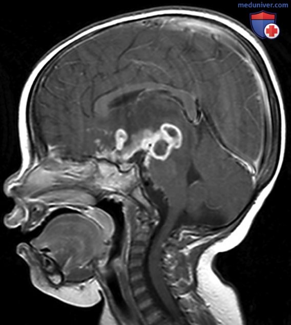 ���������� (Mycobacterium tuberculosis) � �������
