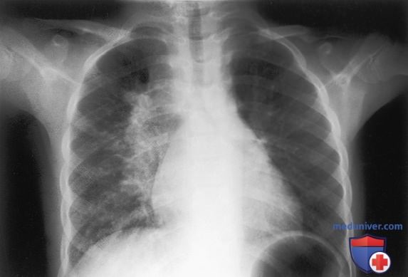 ���������� (Mycobacterium tuberculosis) � �������