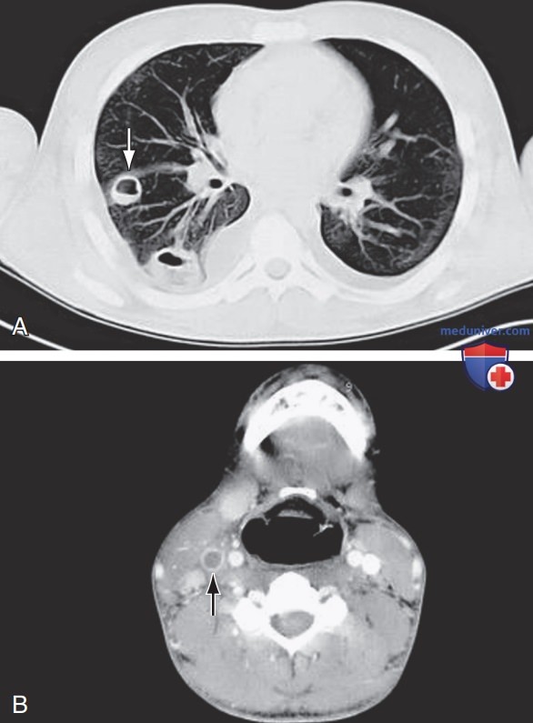 Заглоточный, окологлоточный и перитонзиллярный абсцесс у ребенка ...