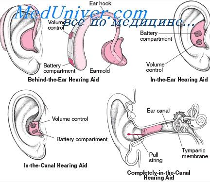 Противопоказания для ношения слухового аппарата thumbnail