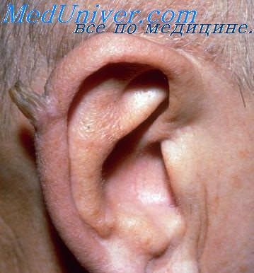 шум в ушах в отоневрологии