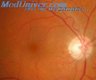 Глазное дно при офтальмоскопии
