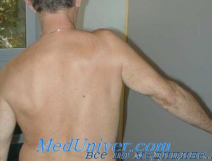 Плече-лопаточный периартрит. Причины периартрита плечевого сустава