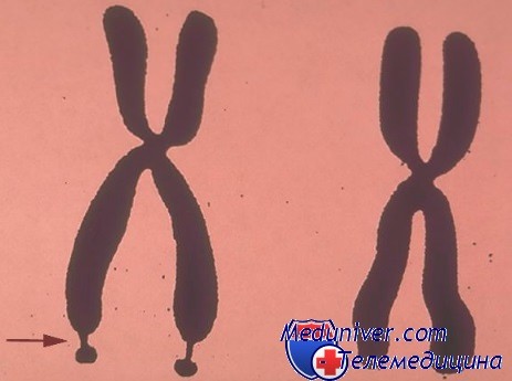 синдром ломкой х-хромосомы