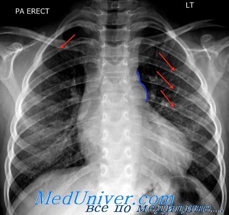 Коарктация аорты на рентгенограмме - узурация межреберных артерий