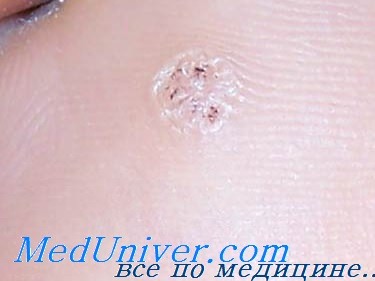 Вирусные инфекции кожи у детей: бородавки, контагиозный моллюск