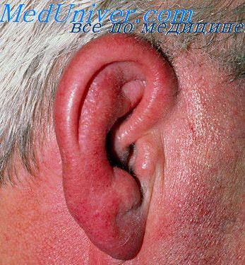 Перихондрит ушной раковины: причины заболевания, симптомы, медицинская помощь