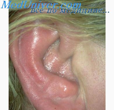 лечение перихондрита уха