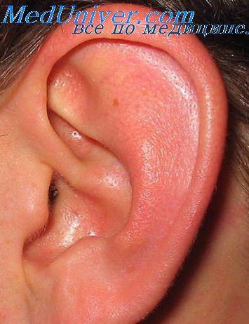 окотенение ушных раковин
