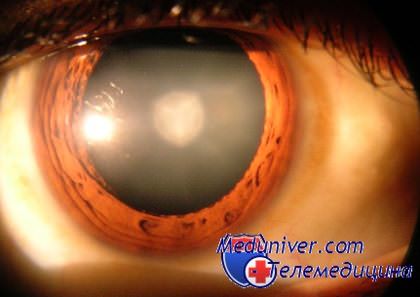 диагностика катаракты