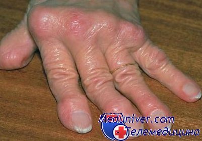 Пальцы при ревматоидном артрите