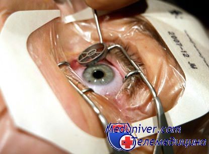 операция на глазах