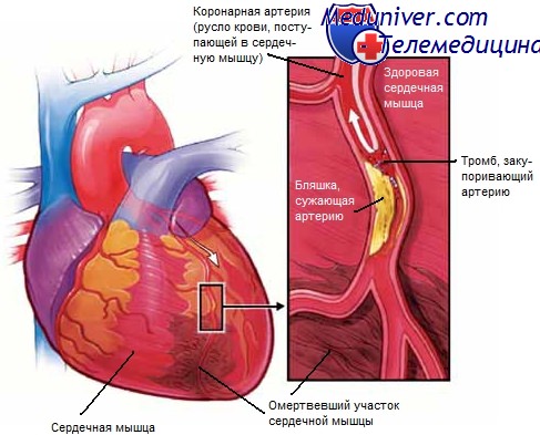 инфаркт миокарда и его признаки