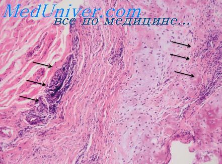 Фиброзирующий альвеолит при ревматоидном артрите thumbnail