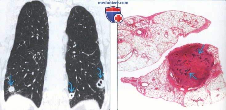 Лучевые признаки поражения легких при гранулематозе с полиангиитом (гранулематозе Вегенера)