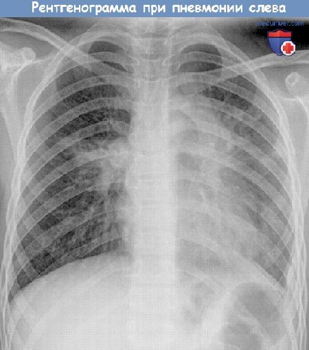 Рентгенограмма при пневмонии у ребенка