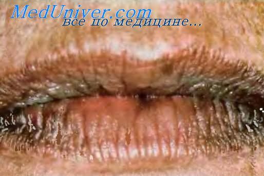 Пигментация губ при болезни Аддисона