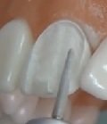 протезирование зубов коронками