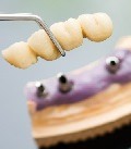 мостовидные протезы зубов