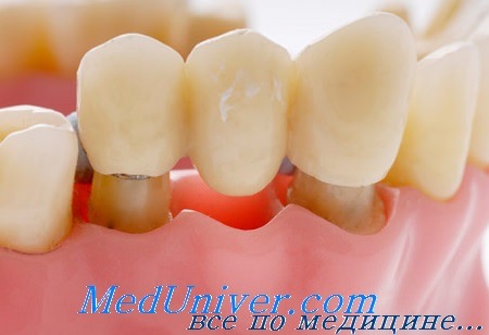 фиксация мостовидных протезов зубов