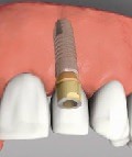 протезирование имплантами зубов