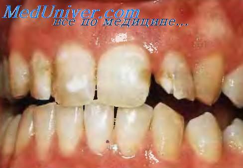 Общее лечение кариеса зубов реферат thumbnail