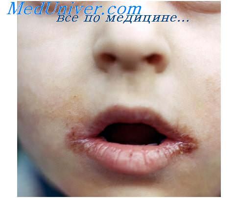 сифилис полости рта у ребенка